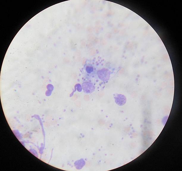 schistosomiasis bladder x ray