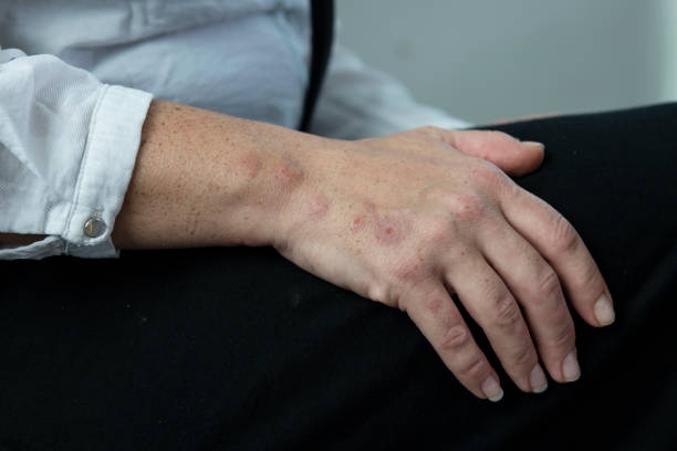 Line of bed bug bites on woman's hand A line of bed bug bites, several days old, on a woman's hand bed bug on skin stock pictures, royalty-free photos & images