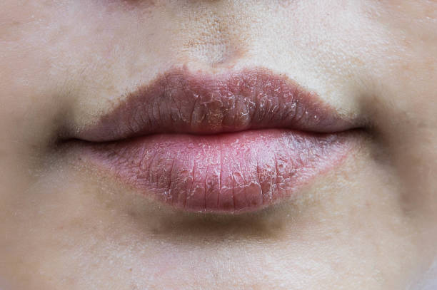 Lips hypersensitive to dry lips, Lips allergic to chemicals , Black lips Lips hypersensitive to dry lips, Lips allergic to chemicals , Black lips dry stock pictures, royalty-free photos & images