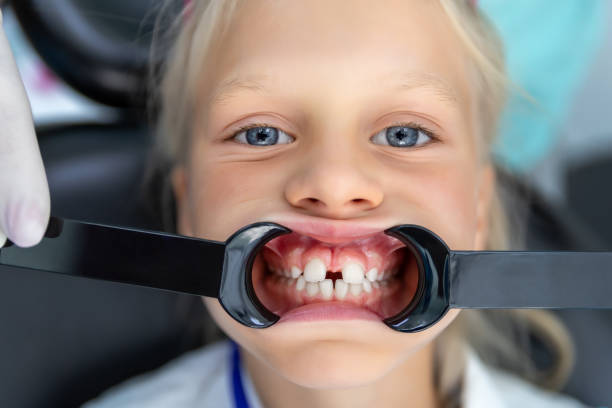 Little blond kid girl at dentist office showing malocclusion and diastema overbite teeth missing gap. Child during orthodontist visit and oral cavity check-up. Children tooth care and hygiene stock photo