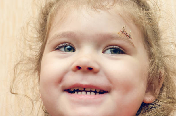 A little girl with a scar above her eyebrow, a deep wound sewn up stock photo