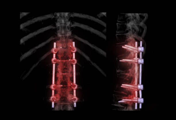 lumbar spine AP and Lateral view  for diagnosis spinal canal stenosis and degenerative disc disease showing pedicle screw implant after surgical decompression and spinal fusion. lumbar spine AP and Lateral view  for diagnosis spinal canal stenosis and degenerative disc disease showing pedicle screw implant after surgical decompression and spinal fusion. x ray plates stock pictures, royalty-free photos & images