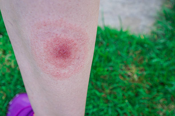 Lyme disease, Borreliosis or Borrelia, typical lyme rash, spot. stock photo