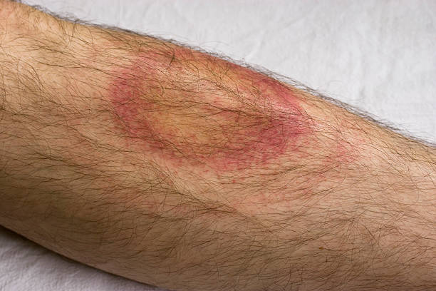 Lyme disease Borreliosis after a tick bite. lyme disease stock pictures, royalty-free photos & images