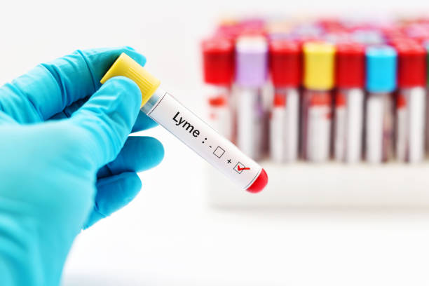 Lyme positive Blood sample positive with Lyme disease lyme disease stock pictures, royalty-free photos & images