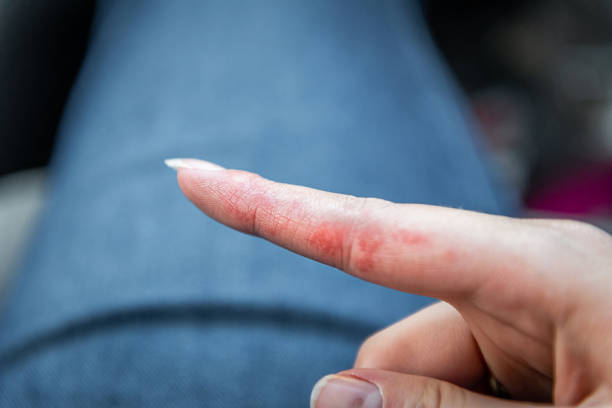 Macro closeup of red patches on index finger skin of female young woman's hand showing eczema medical condition called dyshidrotic pompholyx or vesicular dyshidrosis stock photo