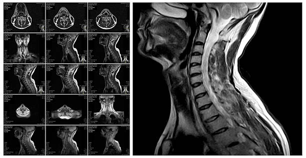 proyección de imagen de resonancia magnética de la espina dorsal cervical. - cuello humano fotografías e imágenes de stock