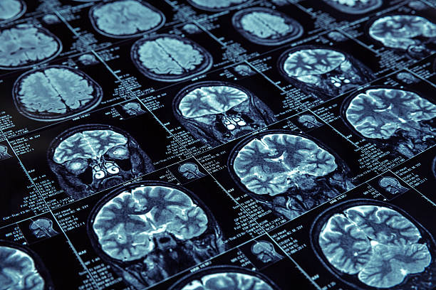 Magnetic resonance imaging Closeup of X-ray photography of human brain  memory loss pics stock pictures, royalty-free photos & images