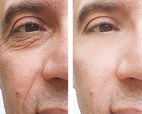 Male Eye Wrinkles Before And After Treatments Stock Photo - Download Image  Now - Anti Aging, Dermatology, Eye - iStock