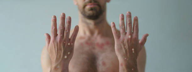 manos masculinas afectadas por erupción con ampollas debido a la viruela del mono u otra infección viral sobre fondo blanco - monkeypox vaccine fotografías e imágenes de stock