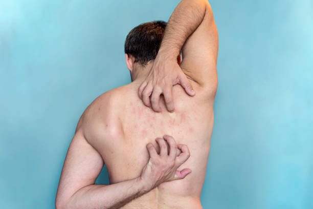 A man scratches the skin on his back. Itching on the back. Man scratching his back on bluy background stock photo
