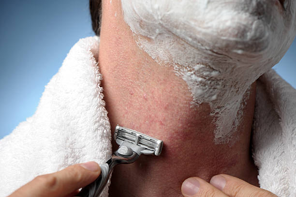 Man Shaving with Razor Burn Close up of man shaving with razor and towel and razor burn and bumps bumpy stock pictures, royalty-free photos & images