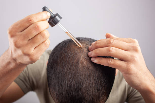 man using minoxidil on bald scalp to treat hair loss minoxidil oil, white background young Caucasian male apply essential oil on scalp by a dropper. Minoxidil stock pictures, royalty-free photos & images
