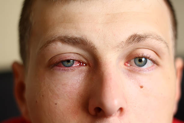 Man with a pink eye stock photo