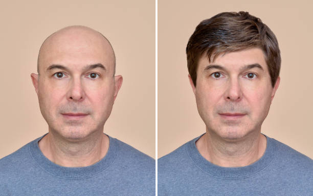 Man with and without hair Two portraits of a same middle aged bald man before and after wearing wig wig stock pictures, royalty-free photos & images