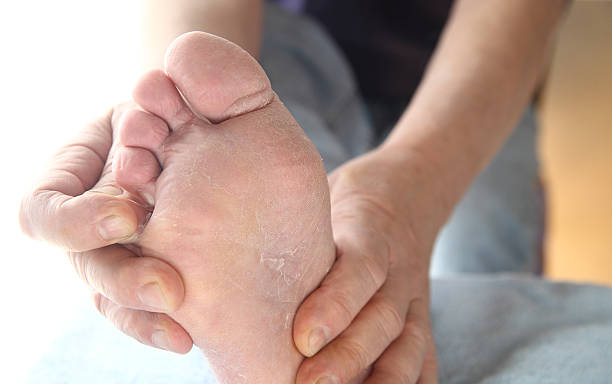 Man with athletes foot itchy skin stock photo