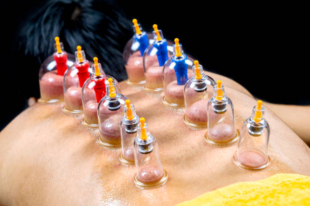 Man with cupping treatment on the back Man with cupping treatment on the back with black background cupping therapy stock pictures, royalty-free photos & images