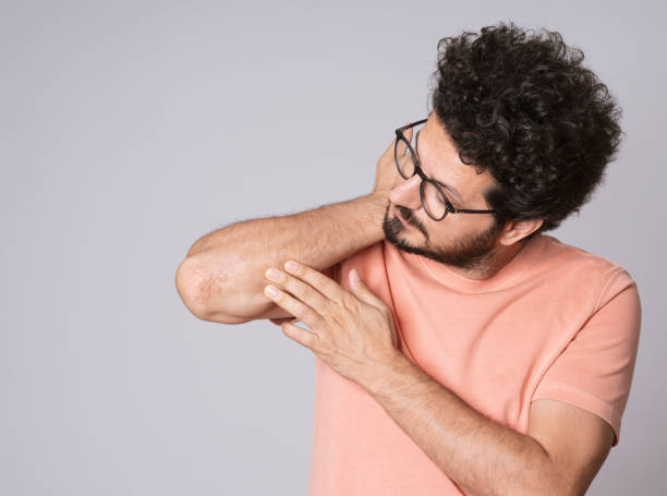 Man with psoriasis on his elbows stock photo