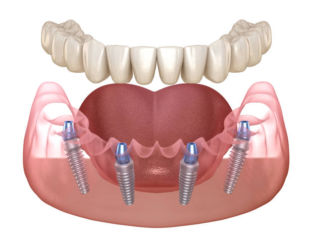 mandibuläre prothese alle auf 4 system durch implantate unterstützt. medizinisch genaue 3d-illustration des menschlichen zähne- und prothesenkonzepts - zahnimplantat stock-fotos und bilder