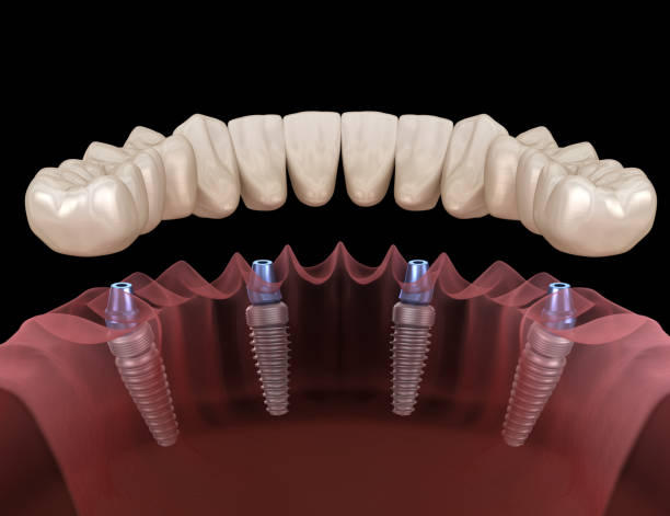 Mandibular prosthesis All on 4 system supported by implants. Medically accurate 3D illustration of human teeth and dentures concept stock photo