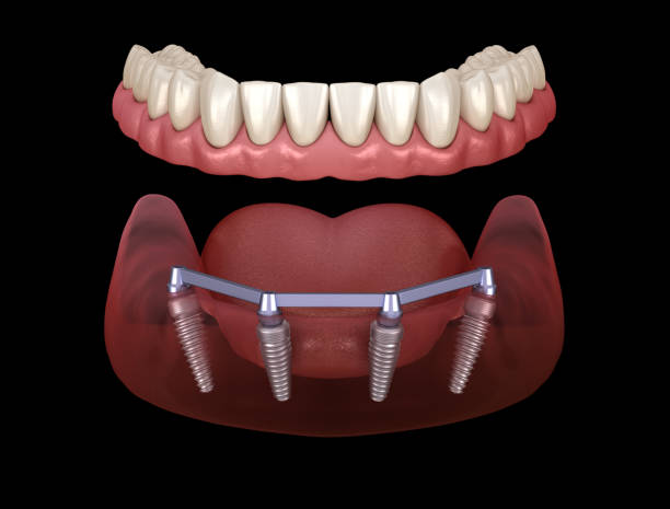 Mandibular prosthesis with gum All on 4 system supported by implants.  Medically accurate 3D illustration of human teeth and dentures concept stock photo