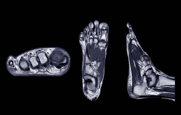 Manetic resonance imaging of foot or MRI FOOT PDW axial, Coronal and sagittal view for diagnostic tendon injury. Magnetic resonance imaging of foot or MRI FOOT PDW axial, Coronal and sagittal view for diagnostic tendon injury. plantar fasciitis stock pictures, royalty-free photos & images