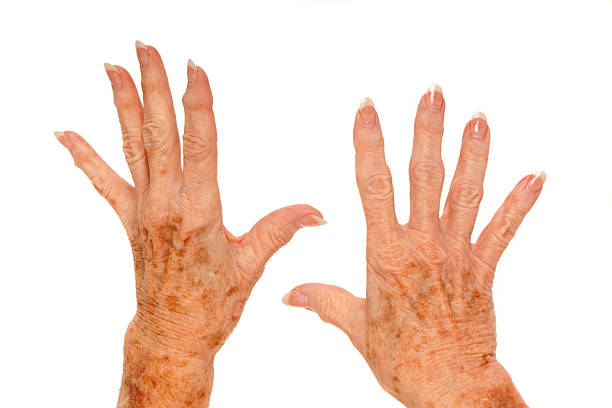 Medical: Rheumatoid Arthritis and Liver Spots stock photo