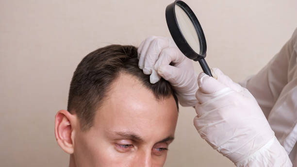 medical worker in gloves and with a magnifying glass examines the head of a balding man close-up stock photo