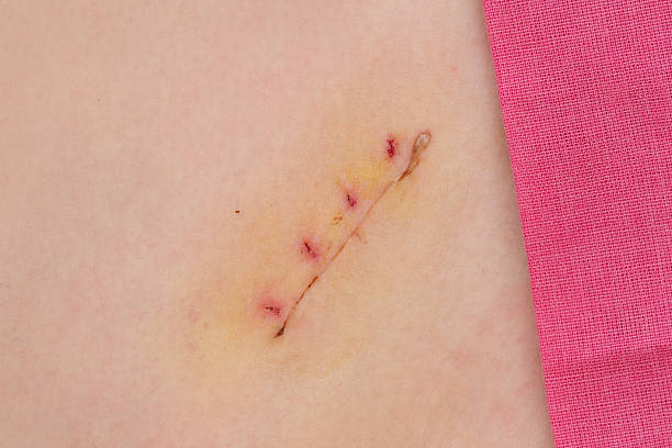 медицина, аппендэктомия операции шрам - appendix scar стоковые фото и изобр...