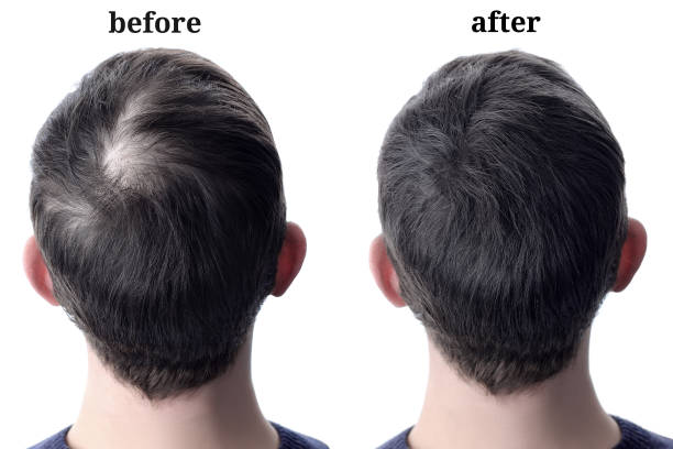 män hår efter att ha använt kosmetiska pulver för hår förtjockning. före och efter - förväntan bildbanksfoton och bilder