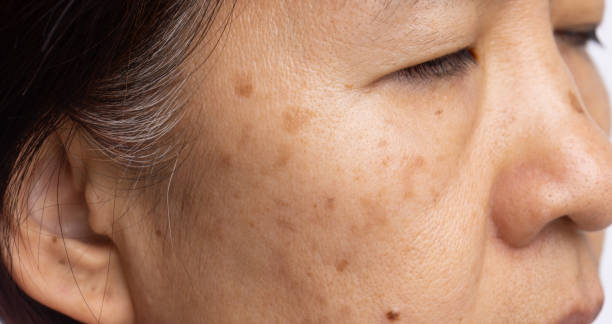 Menopausal women worry about melasma on face. stock photo