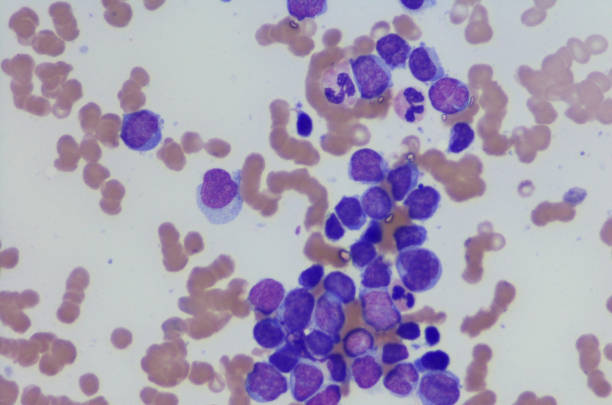 Micrograph of myeloma neoplasm from bone marrow aspirate stock photo