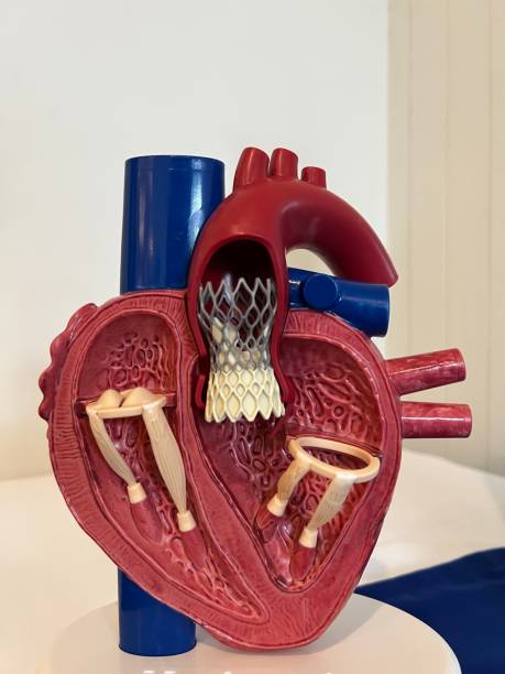 model of endovascular aneurysm repair (evar) for peoples education. stock photo