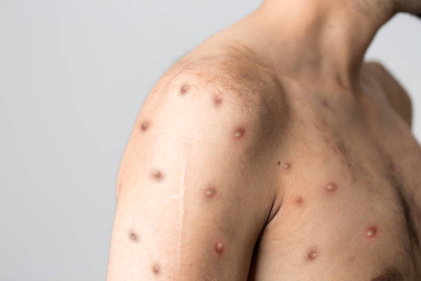 monkeypox new disease dangerous over the world. - monkeypox stockfoto's en -beelden