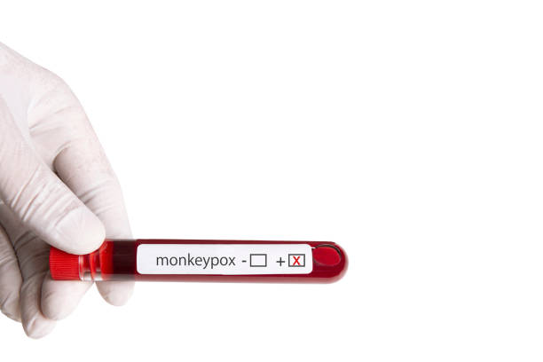 Monkeypox Test Result Monkeypox blood test is positive. monkeypox stock pictures, royalty-free photos & images