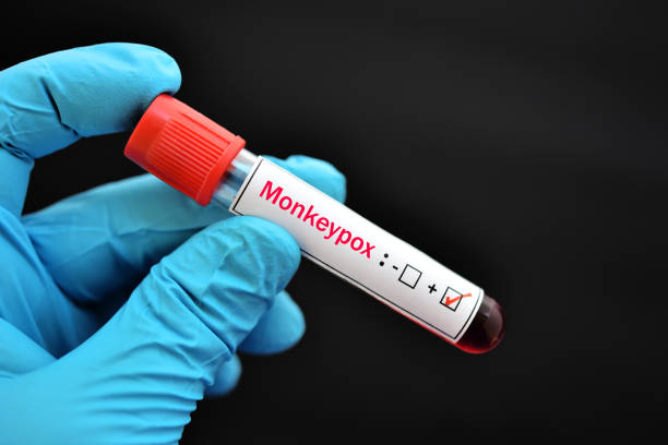 monkeypox virus positive - monkeypox stockfoto's en -beelden