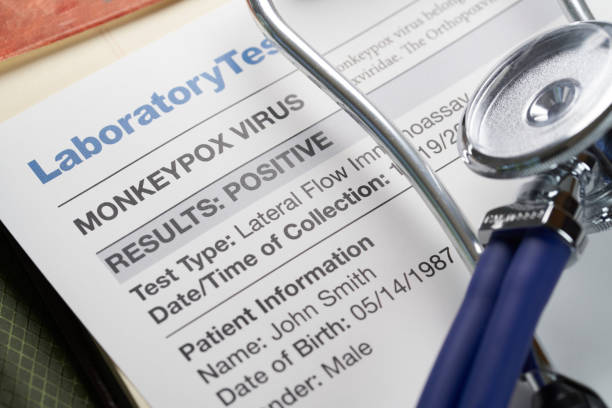 Monkeypox virus test results document with stethoscope stock photo