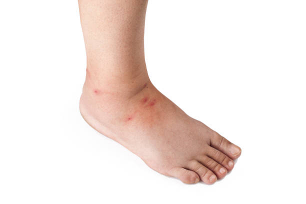 Mosquito bite Mosquito bite bed bug treatment stock pictures, royalty-free photos & images