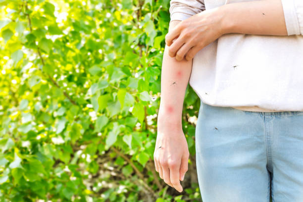 Mosquito bites cause allergies in women. Itchy skin. stock photo