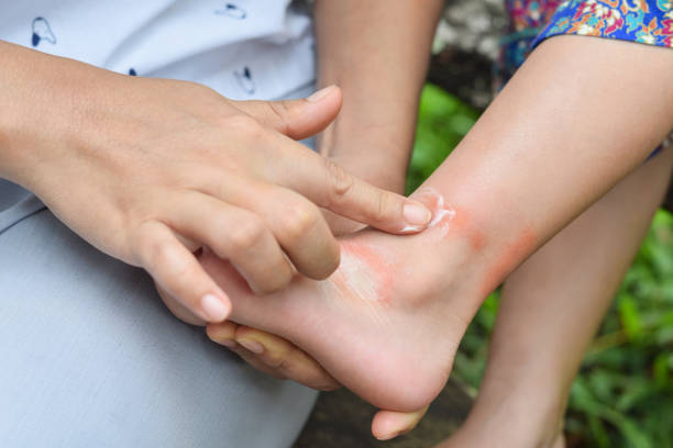 Mother applying medicine to Allergic skin from mosquito or insect bites apply medicine cream to leg,Healthcare And Medicine concept stock photo