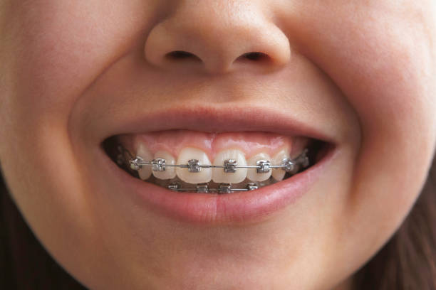 Mouth of a child with dental braces stock photo