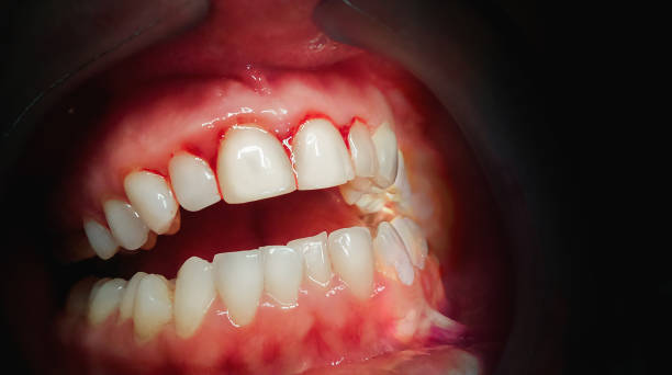 Mouth with bleeding gums on a dark background stock photo