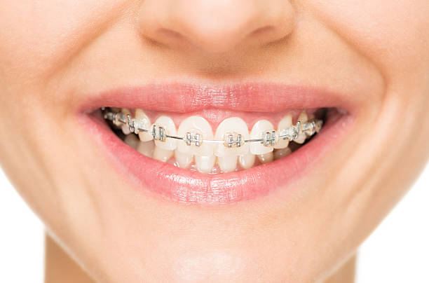 Metal Braces - When you think about braces, you’ll more than likely picture those made of metal — they are certainly the most common. Metal braces are made from high-grade stainless steel and rubber bands are used to attach the wire. Thankfully, these days, metal braces are smaller, more comfortable, and nicer looking than in days gone by. Metal braces now use heat-activated archwires that use your body heat to move your teeth quicker and with less pain. Pros: Metal braces are the least expensive. The o-rings also come in a variety of colors, which allow children to express their personalities. Traditional braces are more effective at treating extreme overcrowding than other options like clear braces or Invisalign aligners and are less expensive. They give your orthodontist the control he needs to move the teeth in small increments at a time. Cons: They are the most noticeable of all types of braces. The main disadvantage of traditional braces is the metal mouth appearance. While less noticeable orthodontics like Invisalign may seem like a better choice for those who are conscious of their appearance, today's braces are more visually appealing than in past years, with a range of color options for both the brackets and the elastics. Wearing these types of braces also means that you don't have to worry about ever misplacing your aligners.