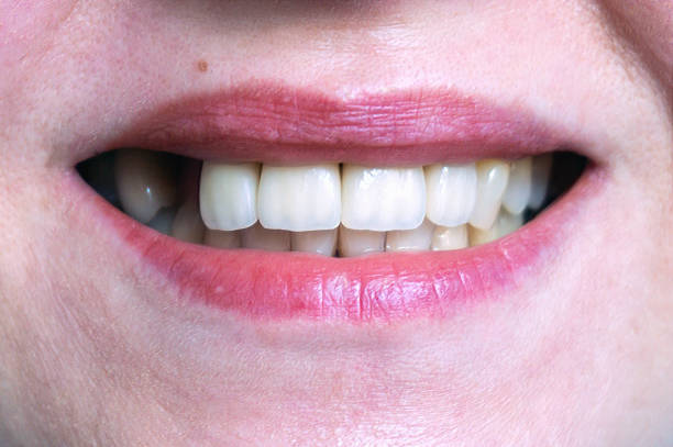 Mouth with four prosthetic upper teeth stock photo