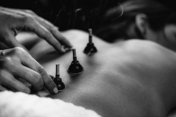 Moxibustion Therapy – Traditional Chinese Medicine stock photo
