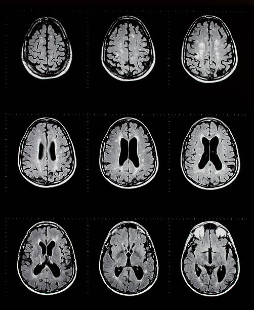 mri of brain showing multiple sclerosis mri exam of the human brain showing multiple sclerosis plaques multiple sclerosis stock pictures, royalty-free photos & images