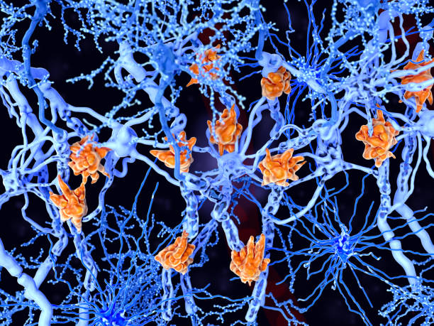 Multiple sclerosis (MS): microglia cells damage the myelin sheath of neuron axons. Multiple sclerosis is a demyelinating disease in which the insulating covers of nerve cells are damaged. Microglia cells (orange) attack the oligodendrocytes that form the insulating myelin sheath around neuron axons, leading to the destruction of the myelin sheath and to the loss of nerve function. multiple sclerosis stock pictures, royalty-free photos & images