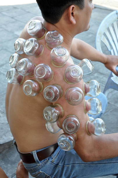 Multiple vacuum cup of medical cupping therapy on human body stock photo