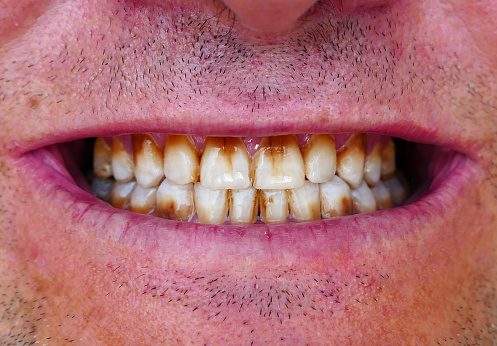 neglected-teeth-yellowed-teeth-oral-heal