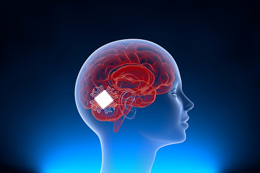 Implanting of Chip in the Brain